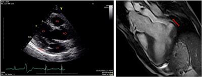 Case report: Aborted sudden cardiac death as a first presentation of severe mitral annulus disjunction—a case series and review of the literature